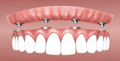 ¿Cómo es la tecnología para hacer implantes dentales?